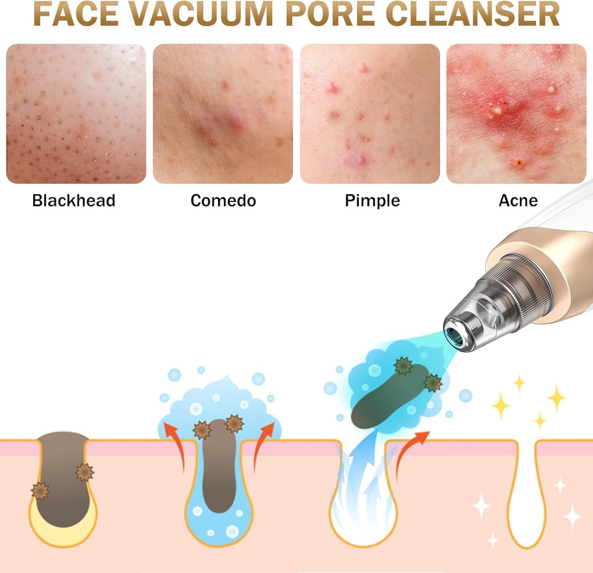 Blackhead Remover Pore Vacuum Kit